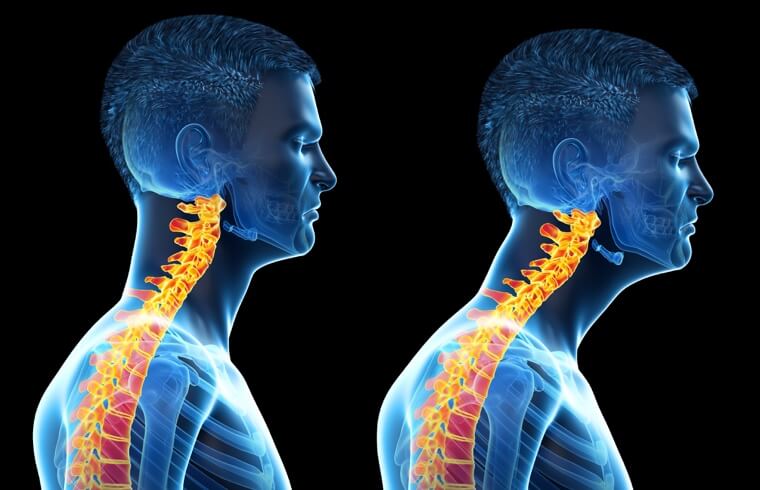 Forward head posture can be a pain in the neck!